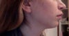 left side of my face- more protruding
