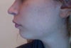 right side of my face- less protruding