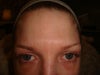 Prior to injections: natural state of forehead.