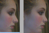 Picture on left is my natural nose. The picture on the right is the nose I would like to have.