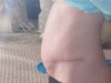 Big bulge now at 6-7 weeks