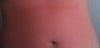 redness_stomach