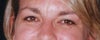 BEFORE - this photo was taken several yrs. before the Bleph, but reflects what I would like to get back to regarding the lower lids, within reason.