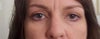 AFTER - 4 yrs. after upper and lower bleph.  Lower eye lids droop and asymmetry.