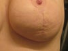close up of left (larger) implant with visible wrinkling, as u feel the area it feels as though the implant is underfilled and bunches up as you touch it and sloches the saline aroung in the implant bag and you are able to feel the saline drain from one side to fill other