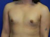 this is before i had the first implants or the second ones