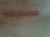 After some polysporin applied
