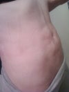 will endermologie only get rid of temporary swelling problems with fluid lumps?