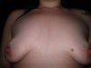 pre-surgery