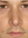 Front view Original Rhinoplasty. I loved the way the cartilage shows through the skin slightly. It gave the nose a chisled look. For some reason I thought the left tip was lower than the right, but the pics prove otherwise.