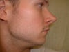 Right side view after tip revision. Look how pointy it is compared to the original