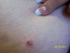 another incision site.