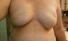 Can't tell that I had amazing breasts prior to surgeries. No Photos Avail.