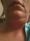 8 hours after surgery the right side is larger than the left