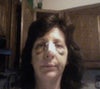 Still Bruised and wondering if nose is still broken or shattered as it made a crunching noise when touched.
