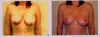 Before and after, 60 cc's diff in implant size
