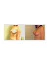 side view larger breast feels like it wasn't lifted