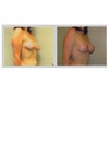 I feel like dr changed nipple placement and added volume but very little lifting