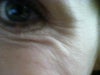 Under-eye wrinkles while smiling.