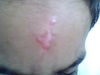 When to remove scar surgically  on 7 year old child, wound 2 month old, what is your expert advice.