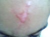 When to remove scar surgically  on 7 year old child , wound 2 month old need expert opinion.