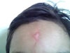 When to remove scar surgically  on 7 year old child, wound 2 month old need expert opinion.