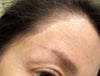 Emily's browlift scar