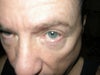 sagging lower eyelid