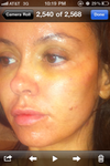 bruising all over my face - green