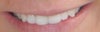 Short and rounded two front teeth
