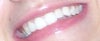 Original teeth before shortened/rounded