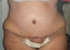 Front view: you can see significant bulge on left side, smaller bulge on right side.