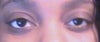 my eyes needs to be lifted,fat need to be removed and they need to be one size.