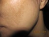 Dark spots are allover the face