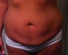 Before Tummy tuck