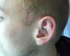 Sideburn scar, widened while the stitches were in it both times.  19 year old so am told the tight surrounding skin could be the cause of this