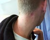 Neck scar, top half is a lump and bottom half is depressed.  Have had about 4 steroid injections over 1.5 years.