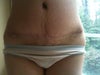 my Tummy tuck front view