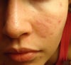 Here you can see some of the enlarged pores on my nose.