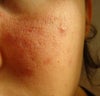 Here is a better view of the scars and pores on my cheek.