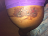this is day 5 No peeling yet! iv been applying Savolon ointment