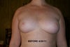 "before implants" A/Small B cup
