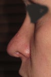 Retracted_Nostril