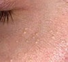 Milia near lower eyelids often form after eye cream use.