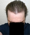 Present view of front top of hairline (wet highlighted hair brushed back)