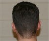 View of the Back of my head (Donor location)
(Hair not highlighted in these)