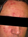 Picture shows the worst condition right. After going through many treatments I am thinking this has something to do with hormonal imbalance. I have had a rough time in last few years dealing with depression and this seems to have gotten worst.