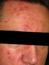 Seems to get worst after a shower or in hot or extremely cold weather. But weird thing is, it was almost gone during my one week vacation in dominican republic!!! I am not convinced this is rosacea.