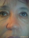 under eye
