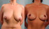 Here is an example of a before and after from RealSelf that I really liked the outcome of. I changed this picture after hearing that what I had previously was not a good example for my shape.